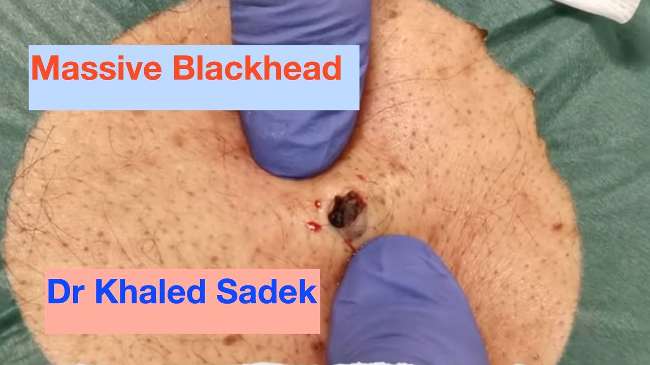 Large Blackhead removal. Dr Khaled Sadek. LipomaCyst.com