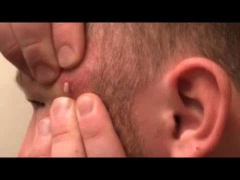 Large Blackheads Cystic Acne Blackheads&Whiteheads Removal Pimple Popping #266