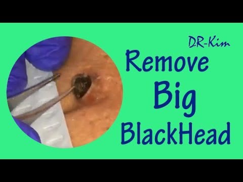 Large Blackheads, Deep Blackheads, Satisfying Popping Pimples Removal