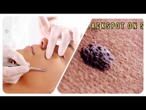 កាត់សាច់ដុះ/LARGE Blackheads Removal – Best Pimple Popping Videos #Blackspot #Treatment