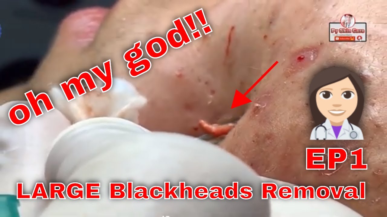 #LARGE Blackheads Removal – Best Pimple Popping Videos|ep1 …
