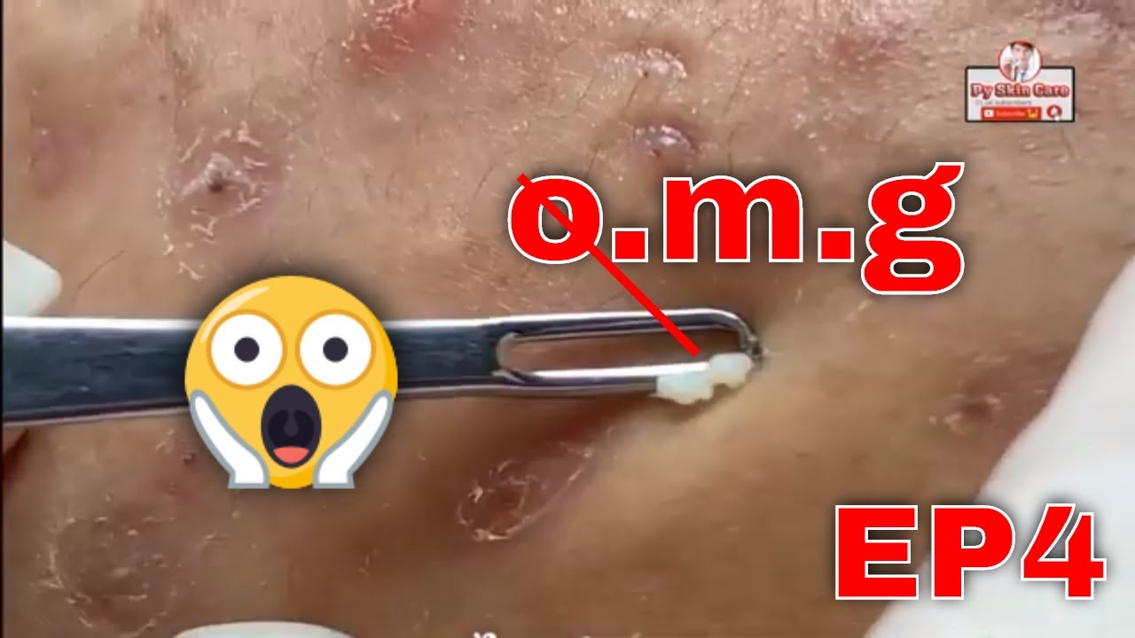 LARGE Blackheads Removal – #Best Pimple Popping |EP4| milia