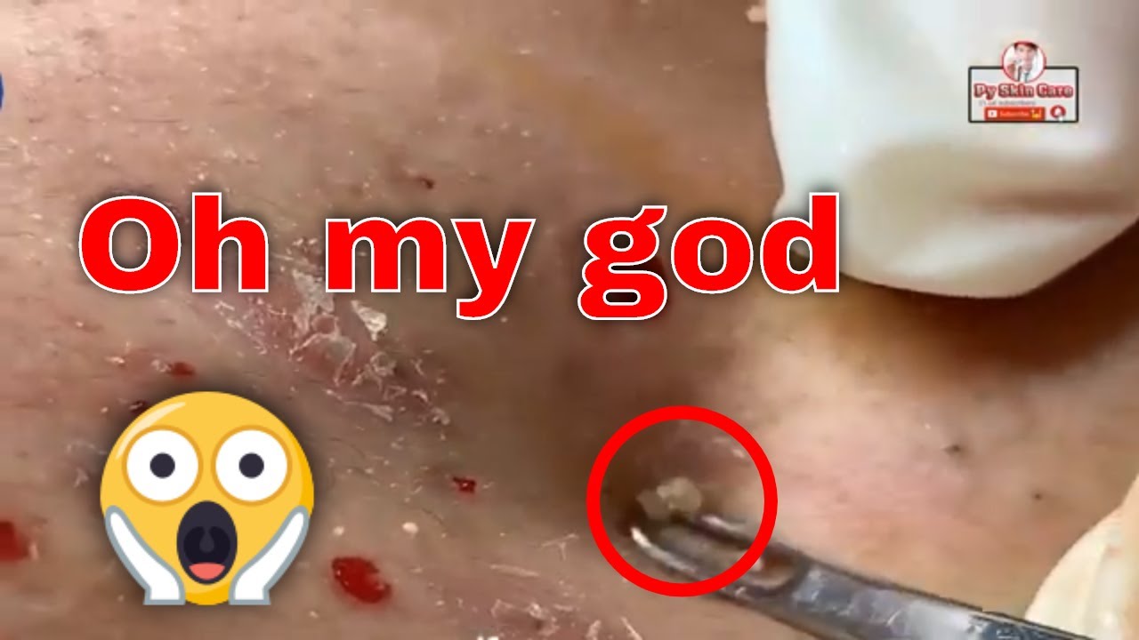 LARGE Blackheads Removal – Best Pimple Popping Videos|EP3| #milia