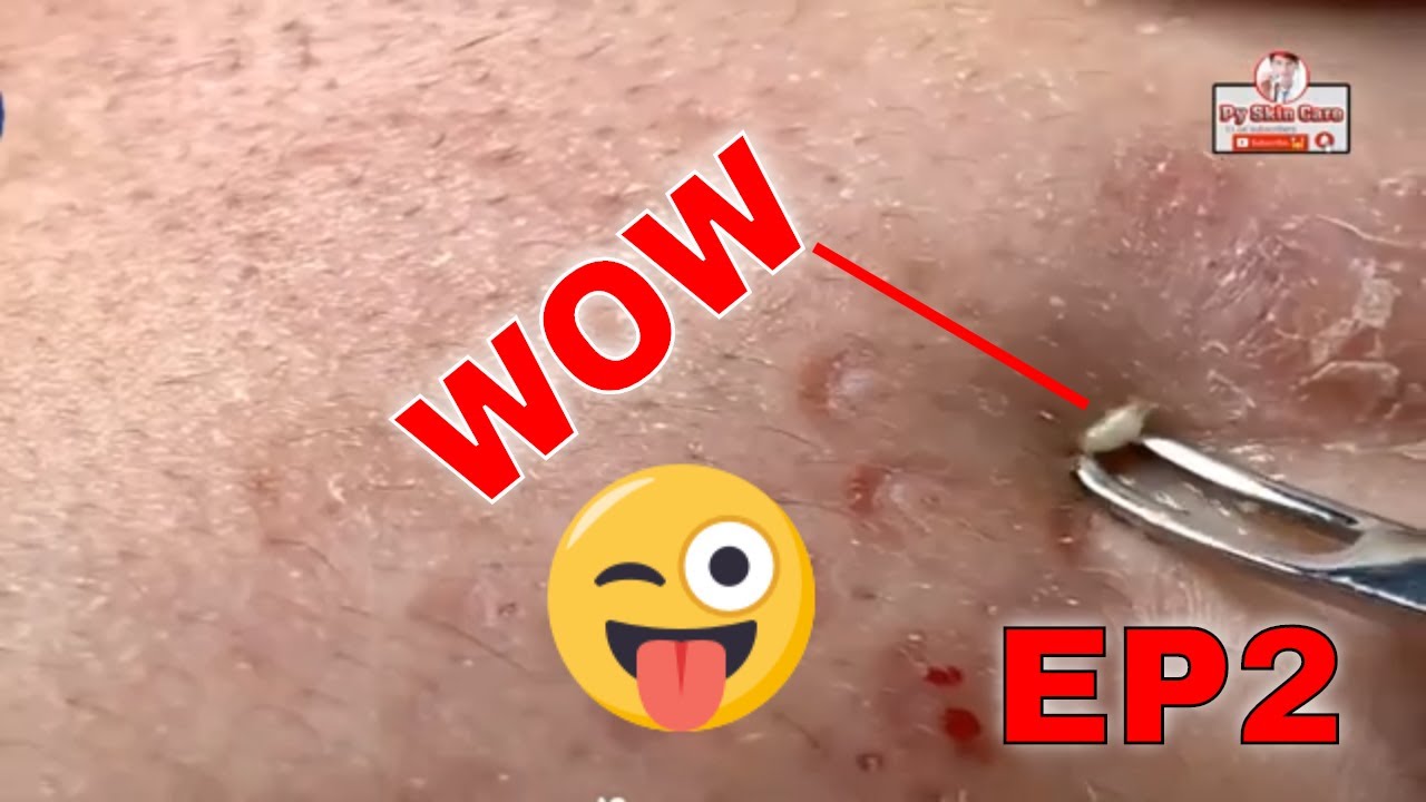 LARGE Blackheads Removal – Best Pimple Popping Videos|EP2| #milia