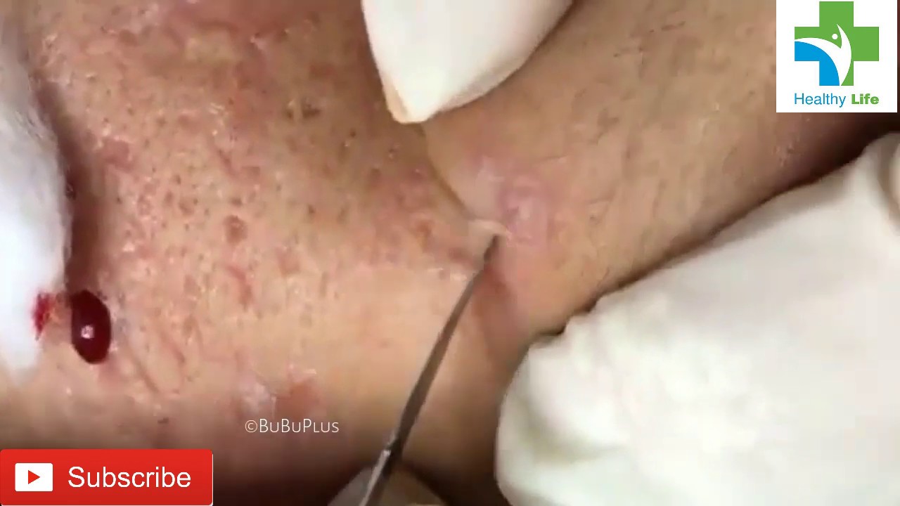 LARGE Blackheads Removal – Best Pimple Popping Videos 2019