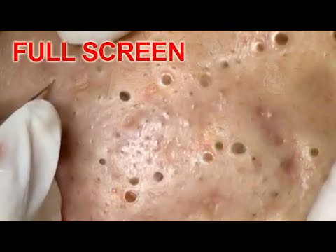 LARGE Blackheads Removal – Best Pimple Popping Videos