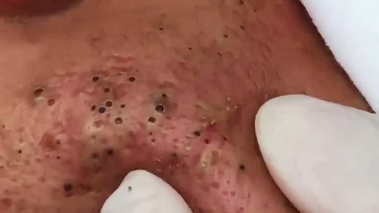 LARGE Blackheads Removal – Best Pimple Popping Videos (46)