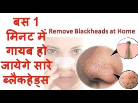 Large Blackheads Removal- Best Pimple Popping videos #कील. #मुँहासे.  #Remedieschannel.