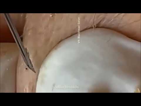 LARGE Blackheads Removal   Best Pimple Popping Videos