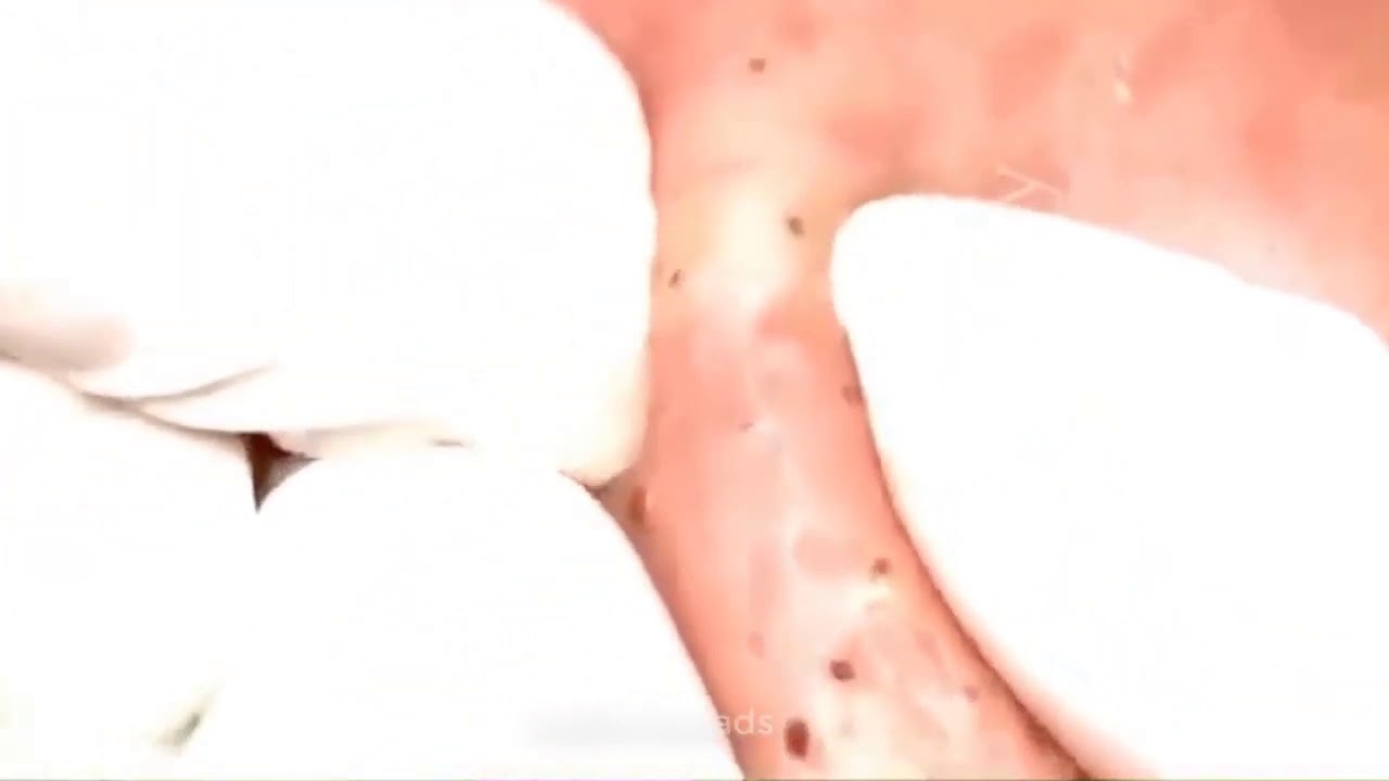 LARGE Blackheads Removal   Best Pimple Popping