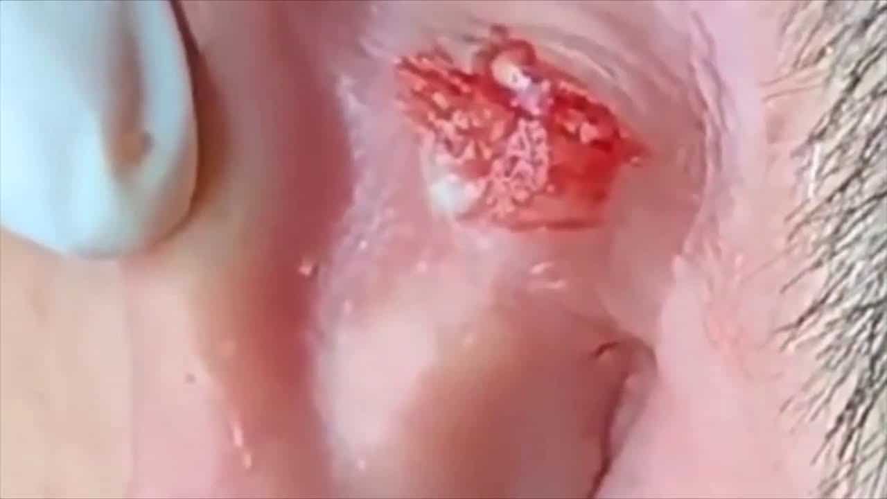 LARGE Blackheads Removal – Best Pimple Popping