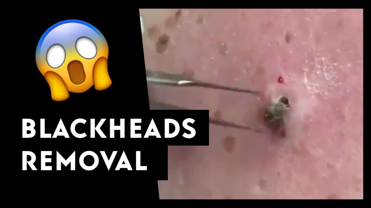 LARGE Blackheads Removal || Blackheads || Best pimple popping videos 15