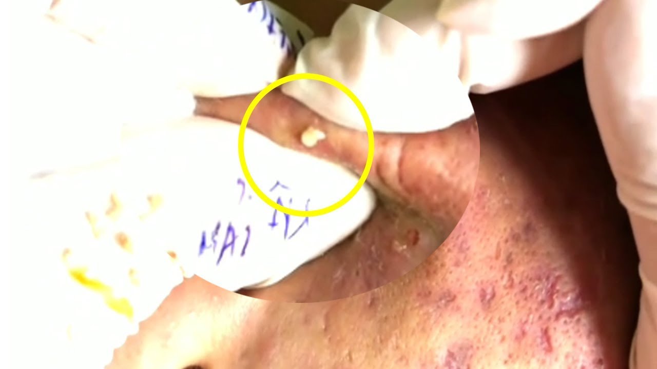LARGE Blackheads Removal-Milia 2019 / pimple popping videos 15/07/2019