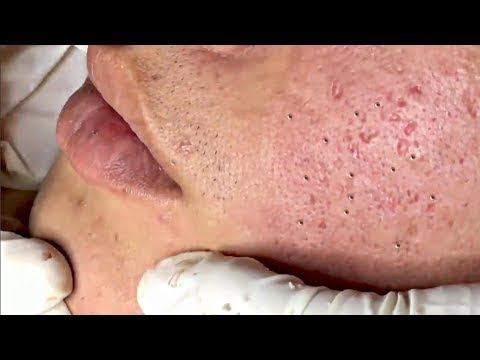 LARGE Blackheads Removal on Face – Best Pimple Popping Videos