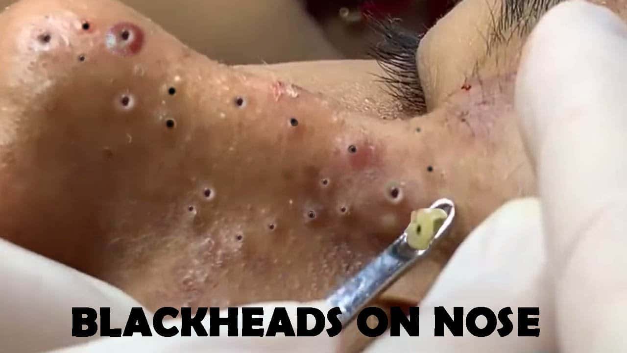 Large Blackheads Removal on Nose