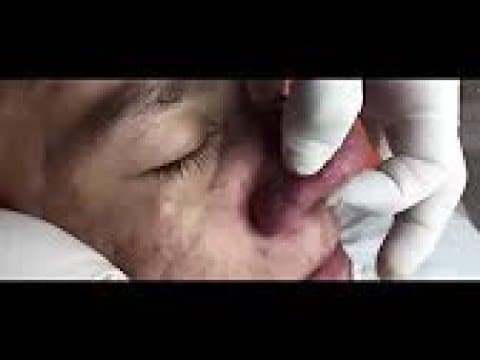 LARGE Blackheads Removal &  Pimple Popping Videos 2020