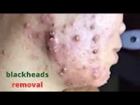 LARGE Blackheads Removal &  Pimple Popping Videos 2020 #blackheads #popping