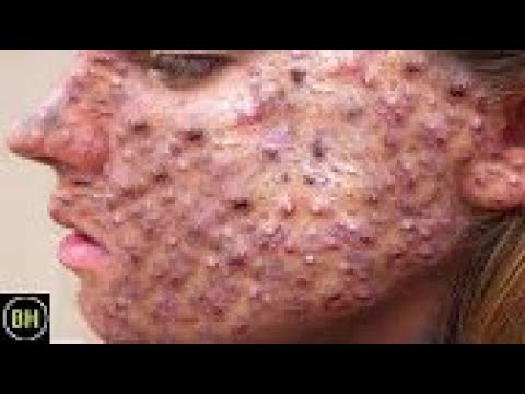 LARGE Blackheads Removal &  Pimple Popping Videos 2020 #blackheads #popping