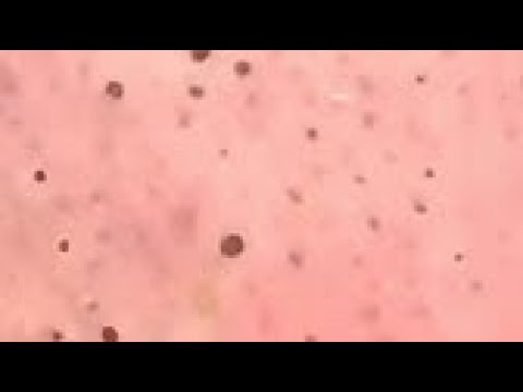 Large Blackheads Removal – Pimple popping videos