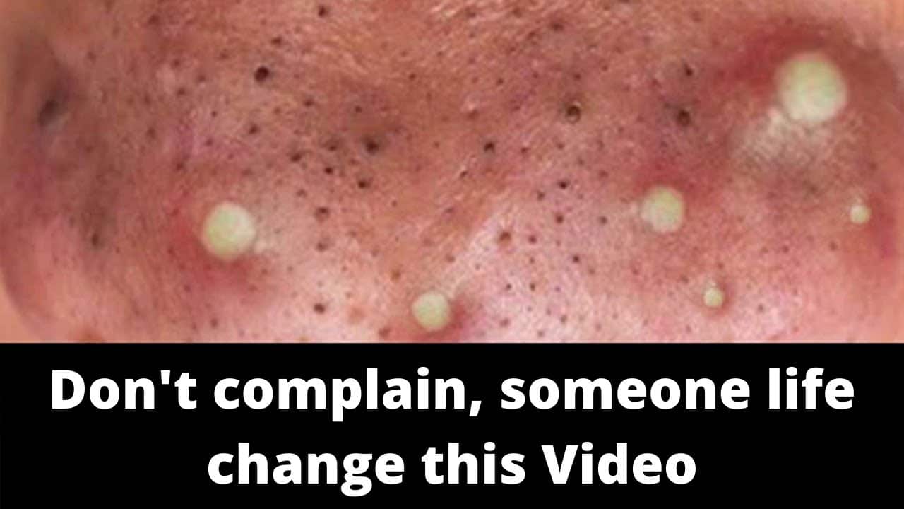LARGE Blackheads Removal & Pimple Popping Videos 2020