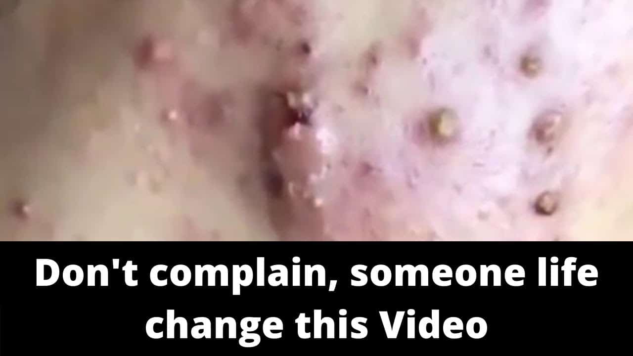 LARGE Blackheads Removal & Pimple Popping Videos 2020