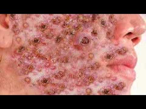 LARGE Blackheads Removal &  Pimple Popping Videos 2020