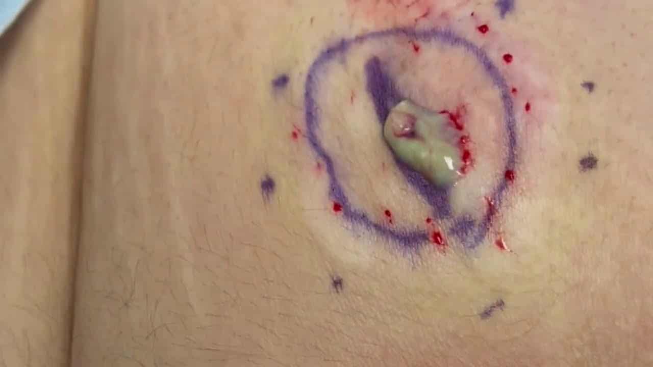 Large Buttock cyst. Green juicy cyst pop. Interesting cyst sac lining surrounded by fat lobules.