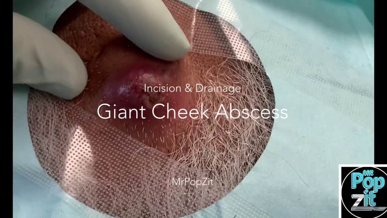 Large cheek abscess. Inflamed cyst pop and drainage. I+D. Dermatology procedure. MrPopZit