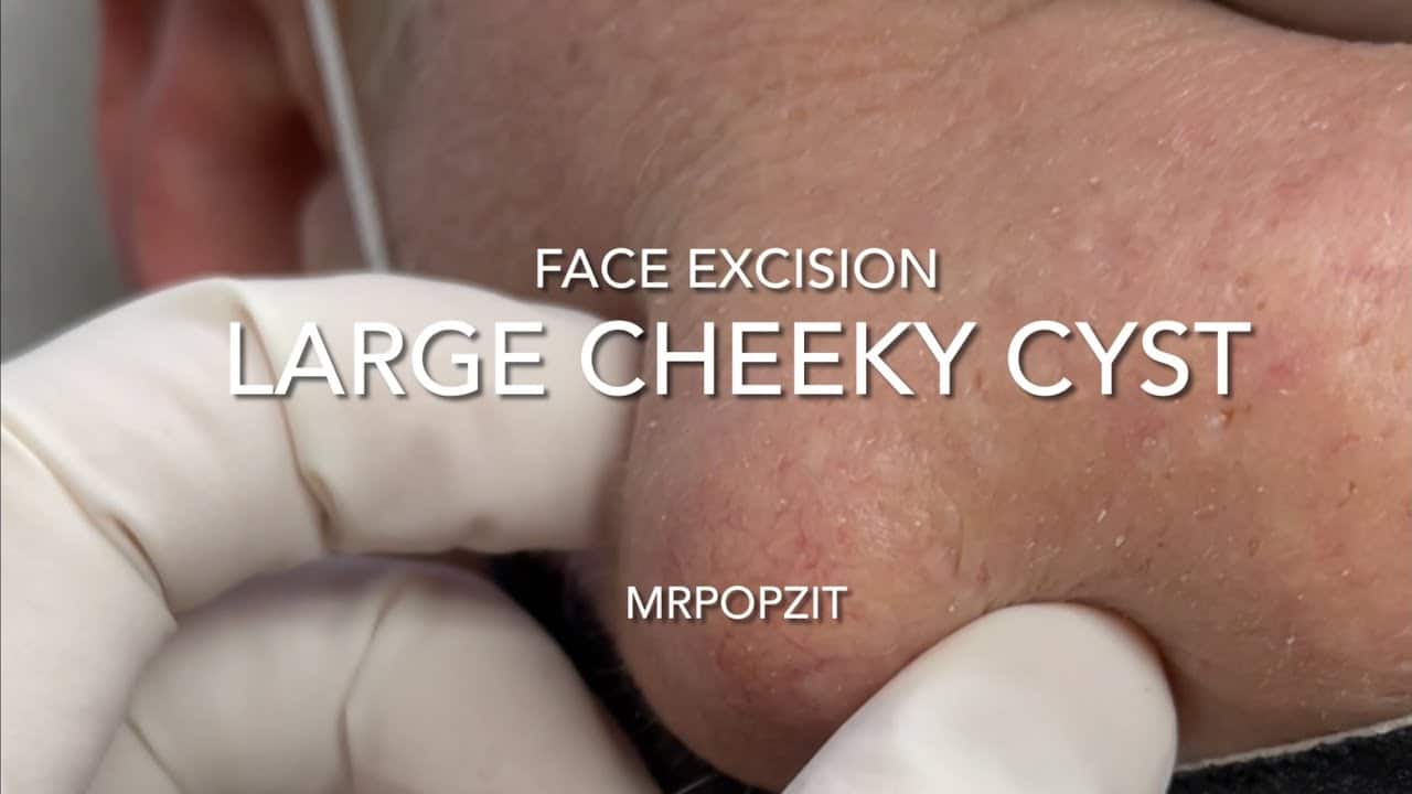Large Cheeky Cyst pops over my head and splatters me. Large face cyst excision with 1 wk follow up.