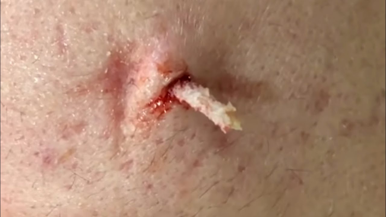 Large Cyst extraction must watch | Blackheads | Whiteheads | Hidden Acne | Satisfying video