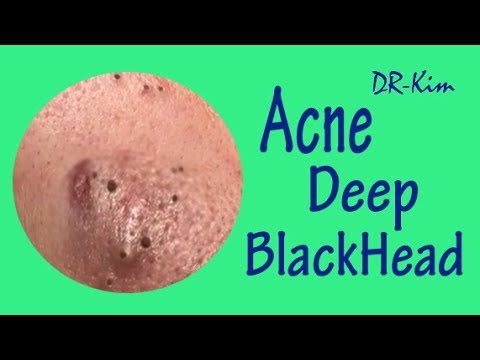 Large Deep Blackheads, Extraction Best Pimple Popping, Satisfying Cyst Acne Treatment Extraction