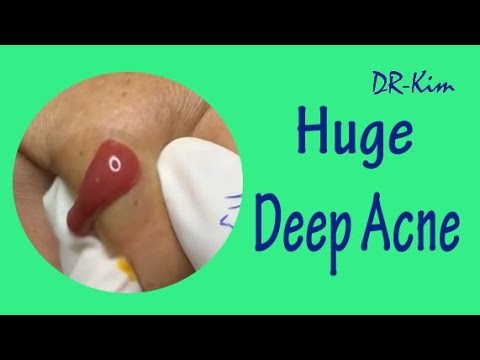 Large Deep Blackheads & Whiteheads, Large Blackheads Extraction Best Pimple Popping