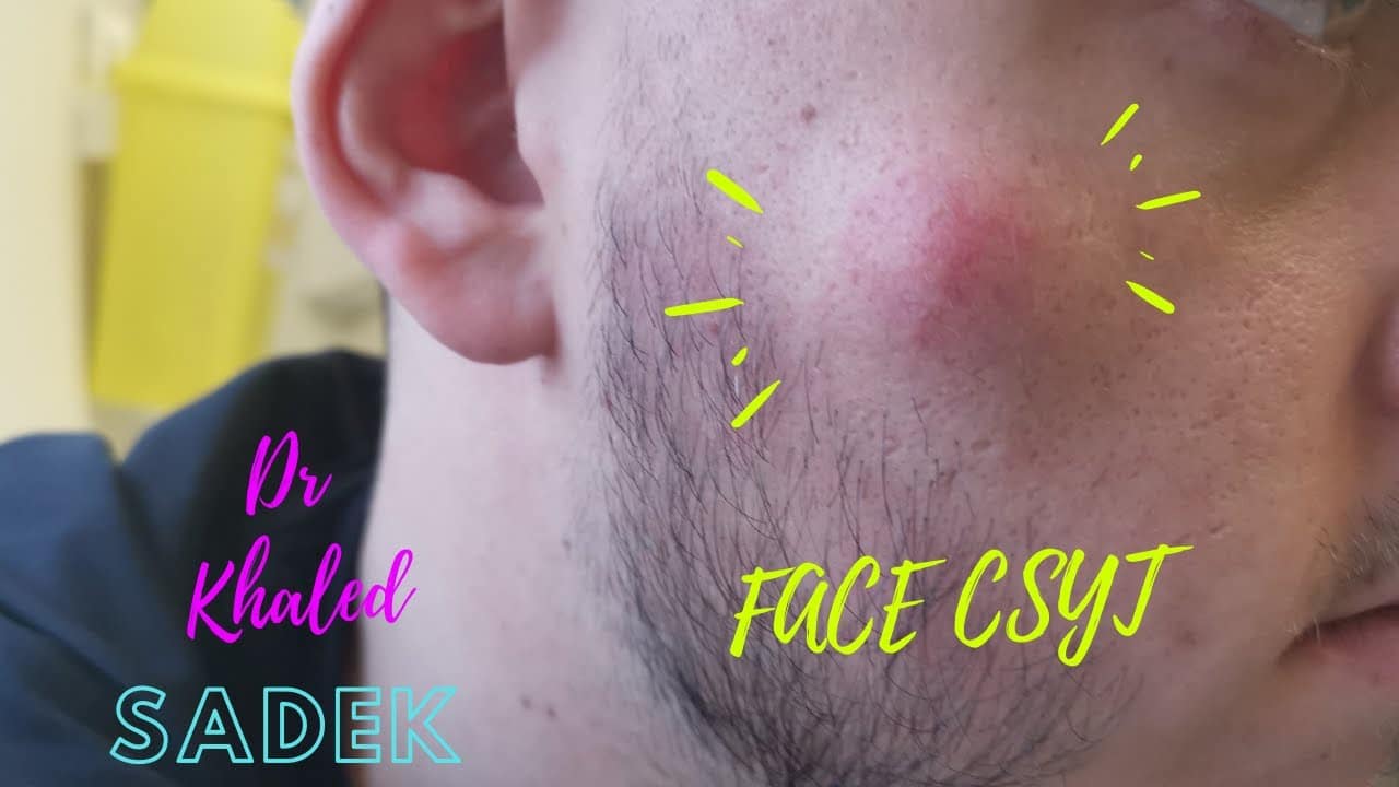 Large Face Cyst Removed. Dr Khaled Sadek LipomaCyst.com