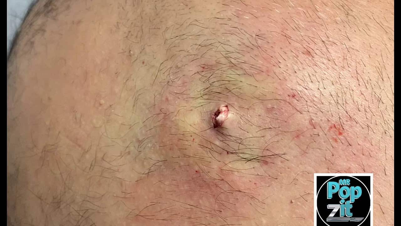 Large inflamed cyst. I+D medical procedure. Large cyst pop. Cyst hits the floor. Juicy pocket.