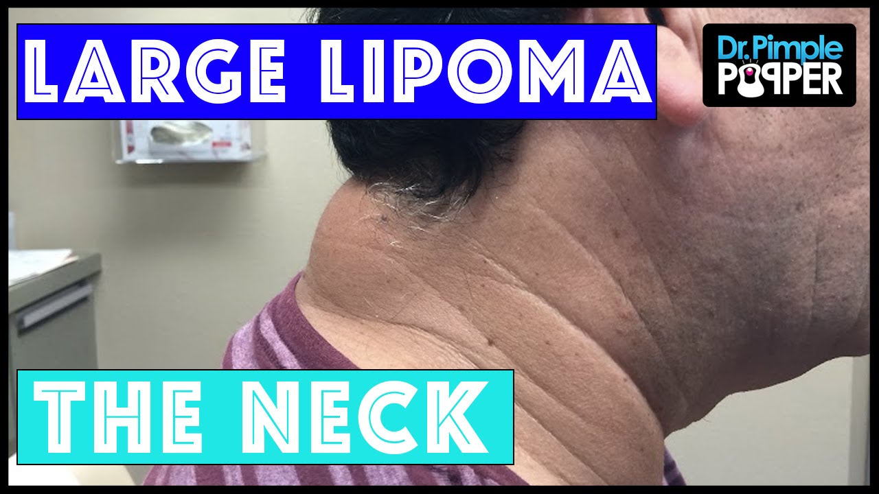 Large Lipoma on the Posterior Neck