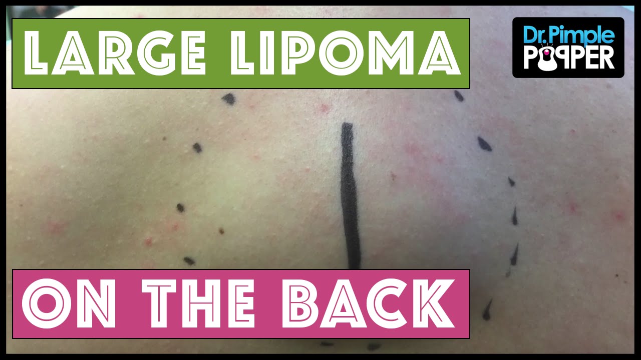 Large Lipoma Popped on the Upper Mid Back by Dr Pimple Popper
