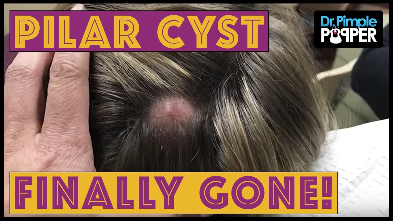 Large Pilar Cyst Finally Gone!