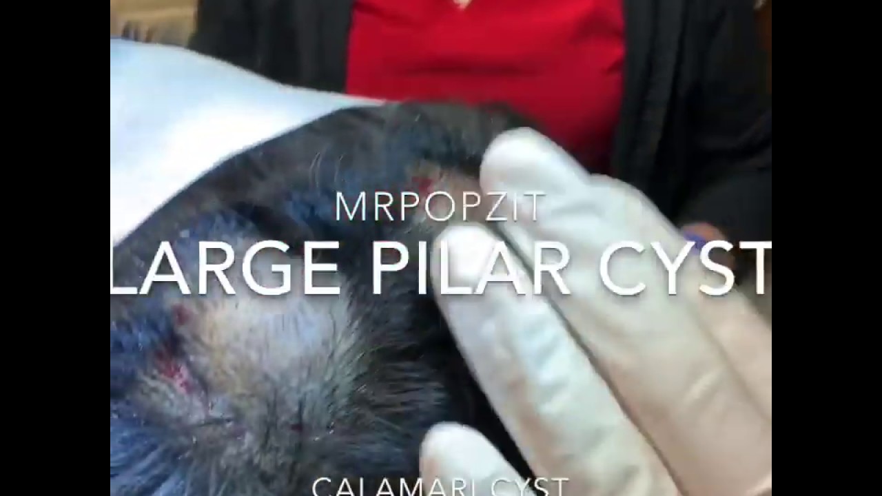 Large Pilar cyst popped. Exploding cyst! If you like cyst pops look no further. Just the Pop.