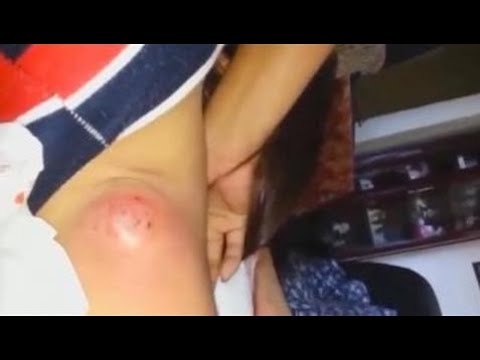 Largest cyst of 2017 Pimple popping & Blackhead extraction