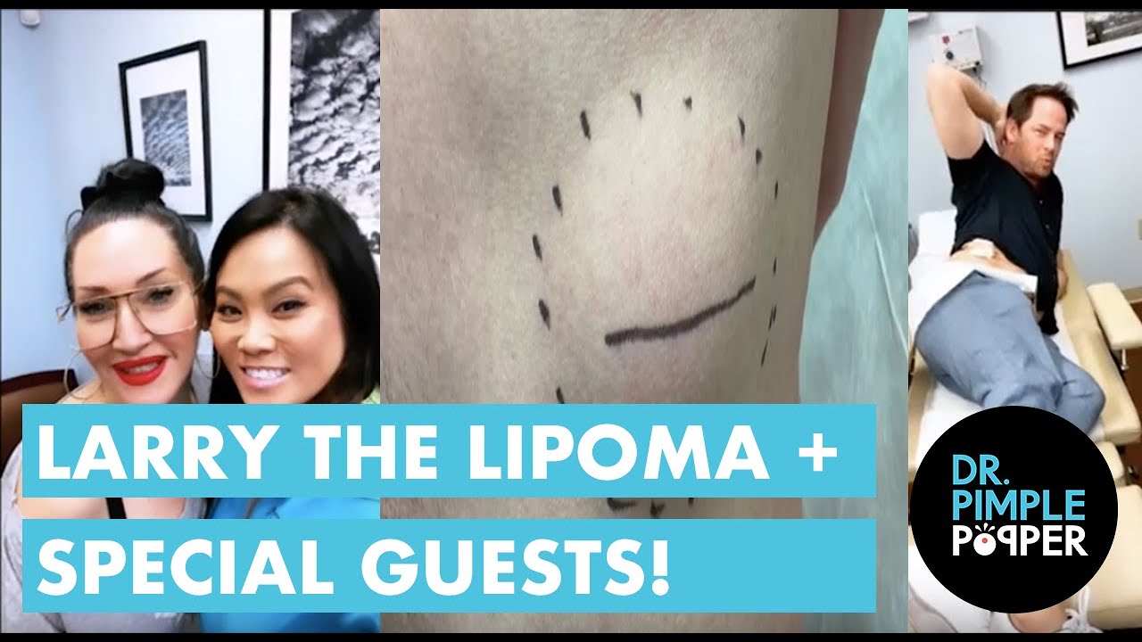 Larry the Lipoma + Special Guests
