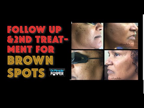Laser treatment for brown spots, part 2