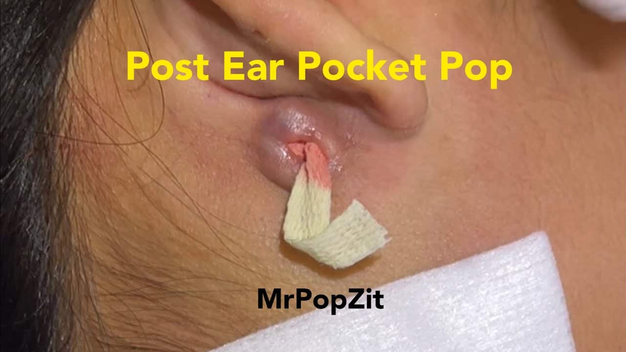 Lava flow post ear cyst pop. Pocket drained and packed. Pressure relieved. Patient feels much better