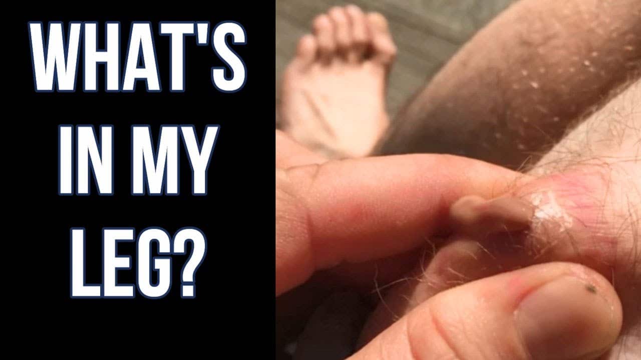 Leg Cyst Bursts!  What's In My Leg?  Pimples, Cysts & Popping