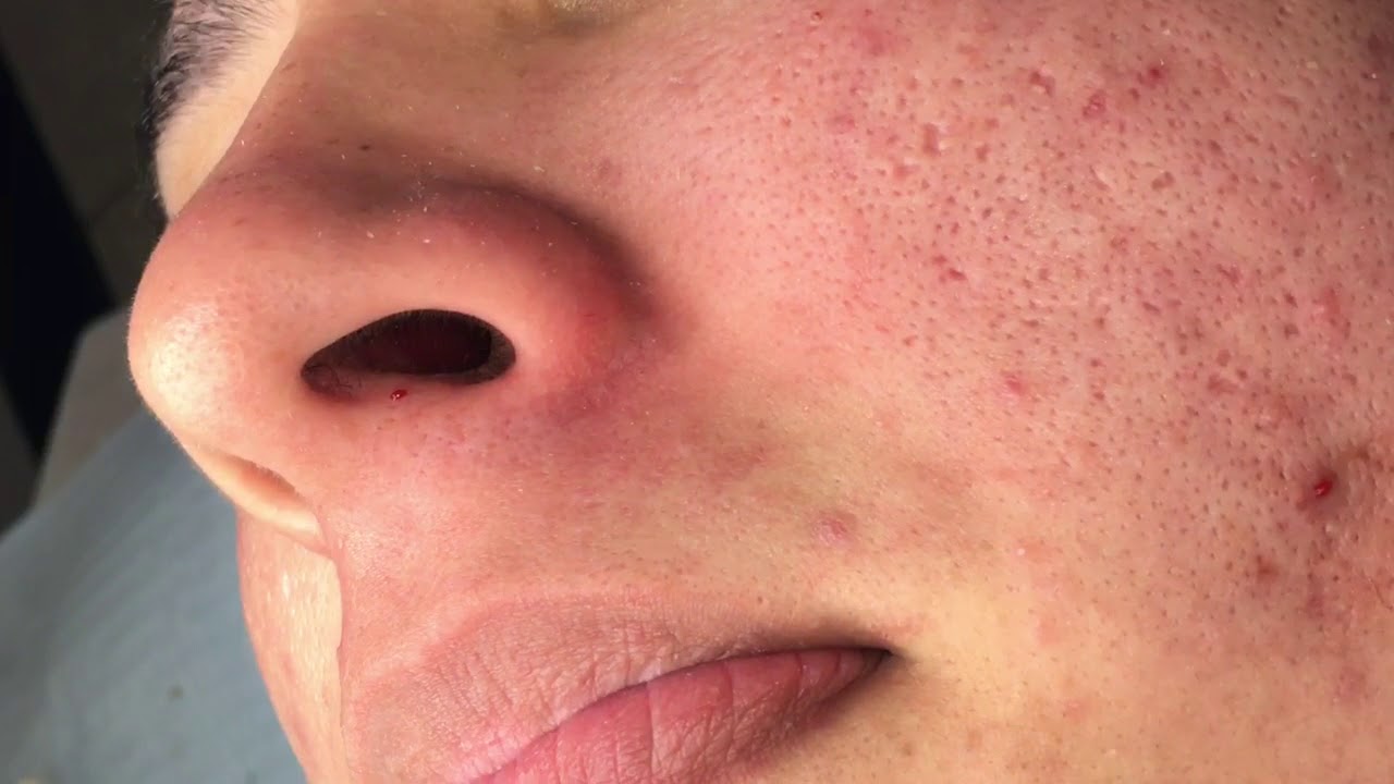 Leslie’s Acne Treatment Part 4