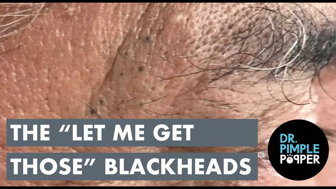 “Let Me Get Those” Blackheads