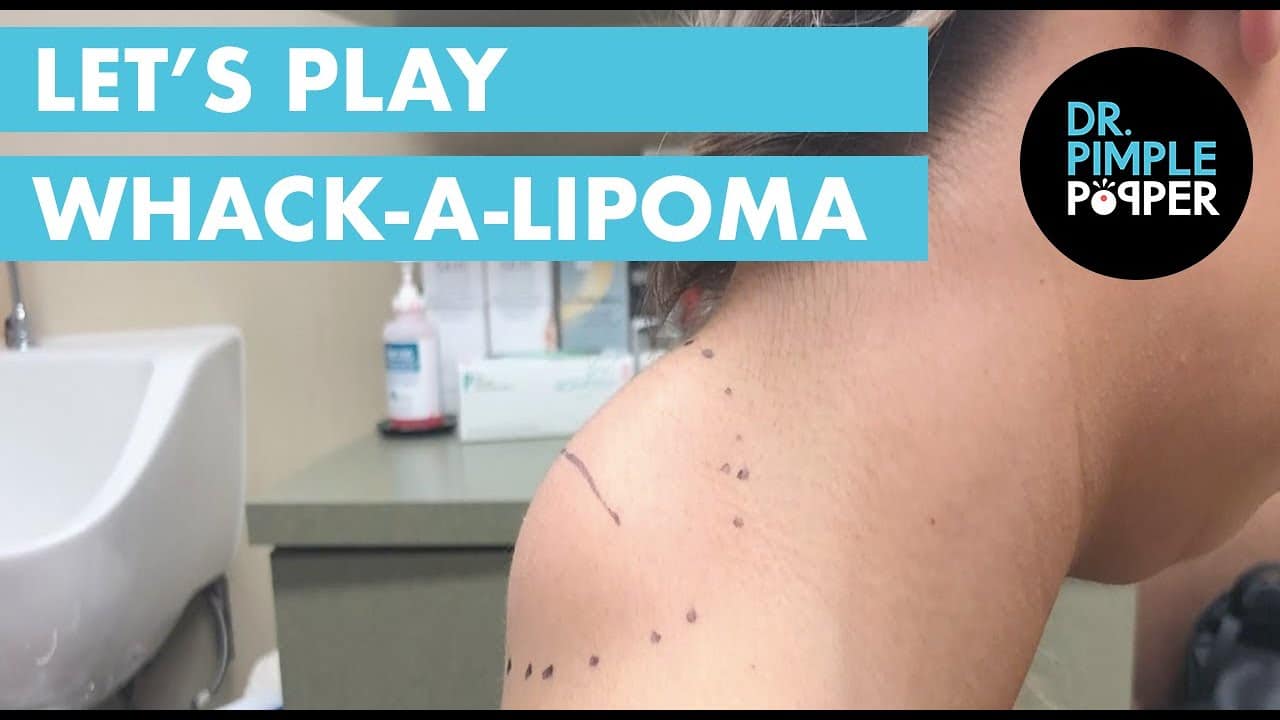 Let’s Play “Whack-A-Lipoma”!