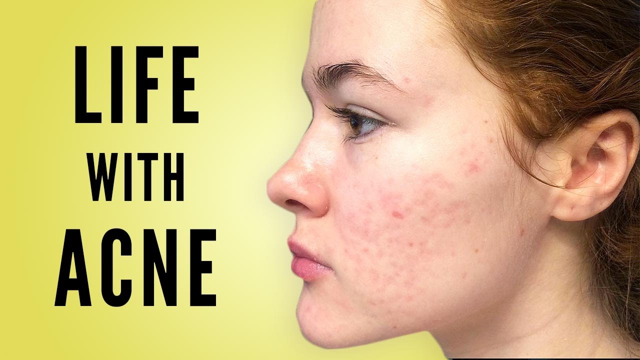 LIFE WITH ACNE