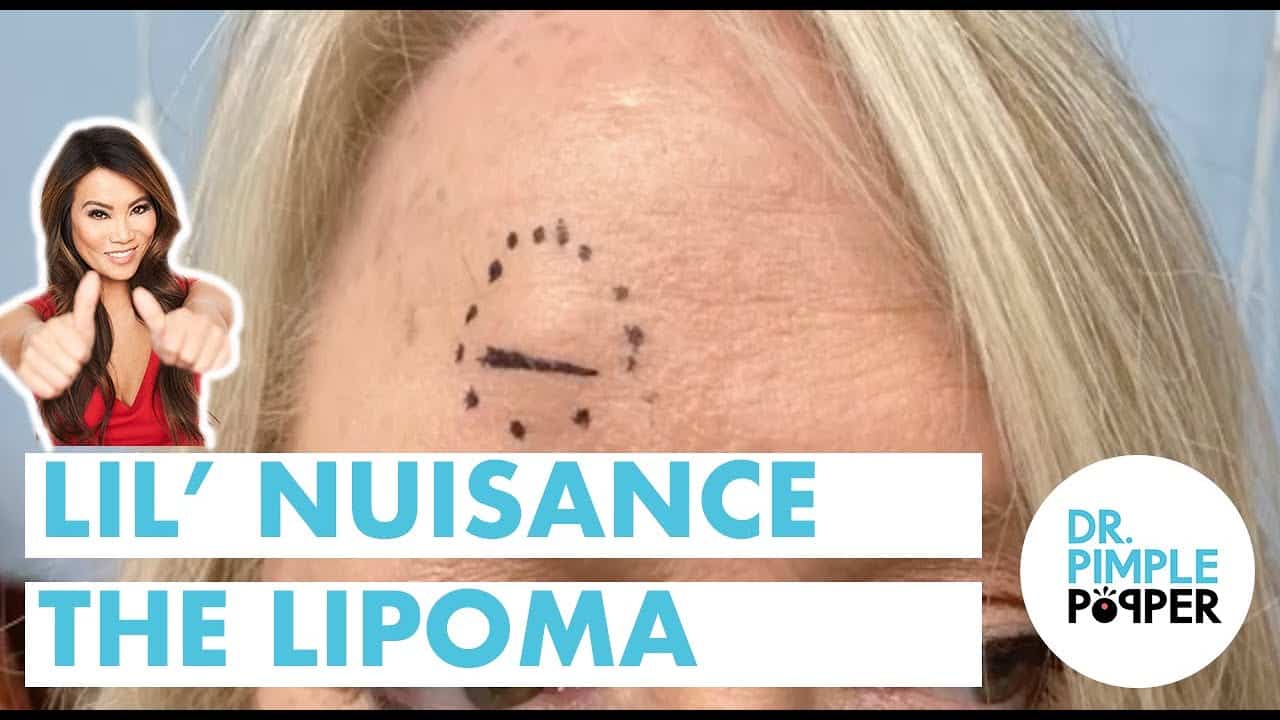 Lil’ Nuisance the Lipoma