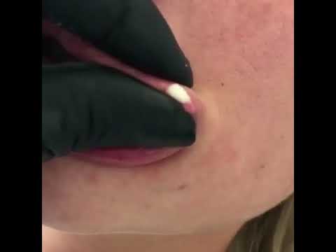 Lip filler gone WRONG! Pimple popping. Filler removal.