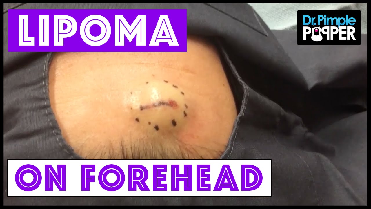 Lipoma excision on the Right Forehead: Dr Pimple Popper